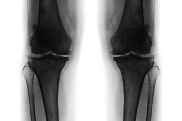 Osteoarthritis Treatment