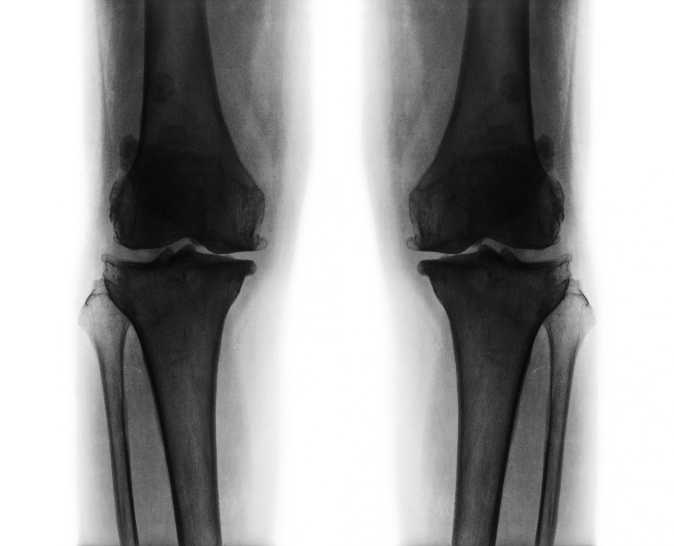 Osteoarthritis Treatment
